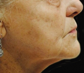 Dermatology & Laser of Alabama after — Birmingham, AL