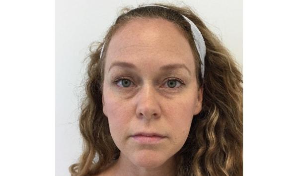 Lip Filler before at Dermatology & Laser of Alabama in Birmingham, AL