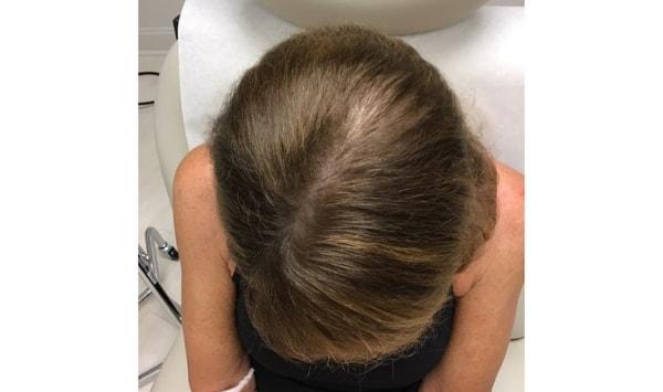 Dermatology & Laser of Alabama hair restoration after — Birmingham, AL