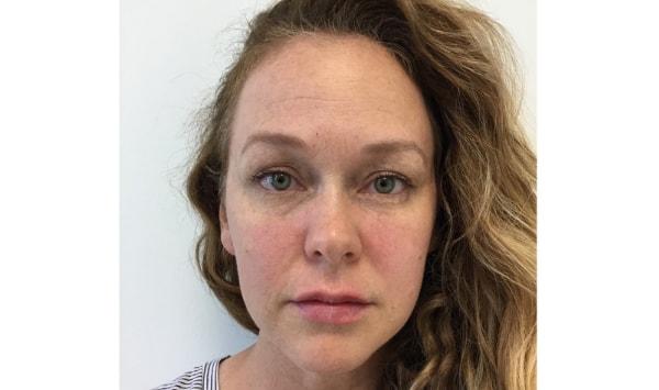 Dermatology & Laser of Alabama lip filler after — Birmingham, AL