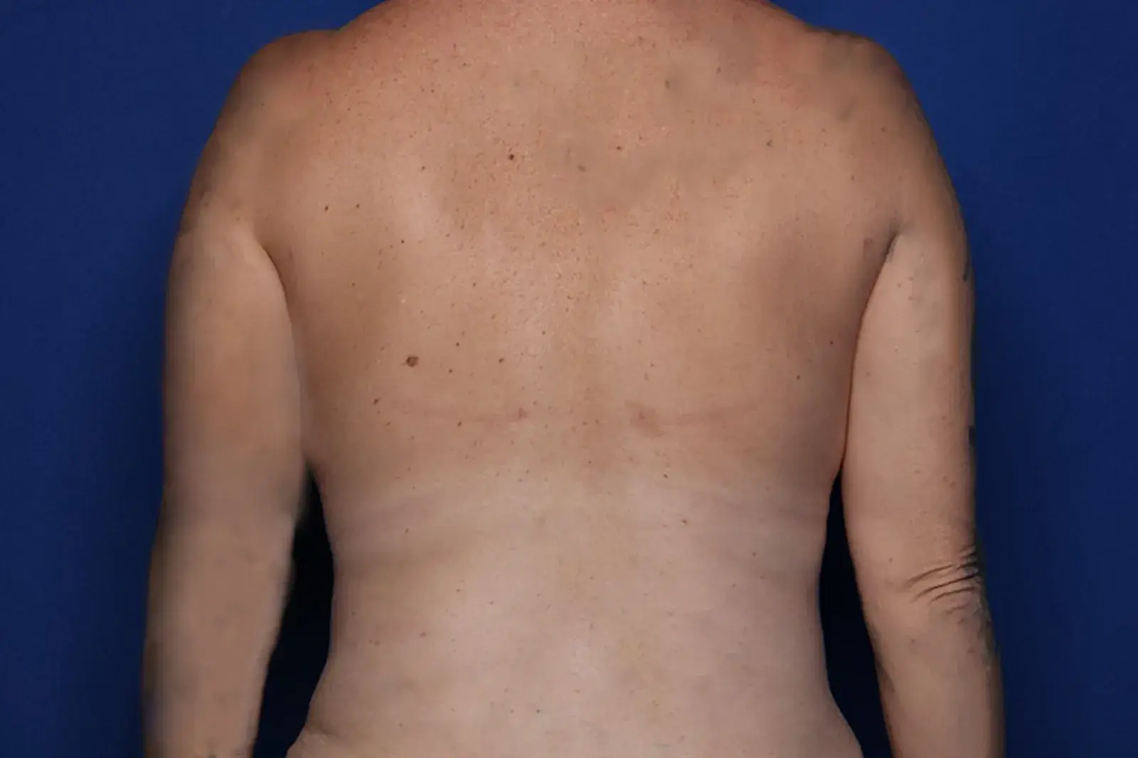 Setty Plastic Surgery liposuction after — McKinney, TX