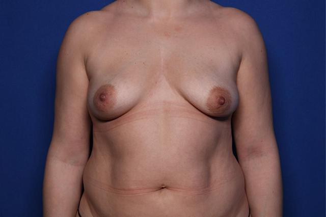 Breast Augmentation before at Setty Plastic Surgery in Frisco, TX