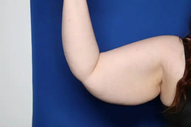 Arm Lift before at Setty Plastic Surgery in McKinney, TX