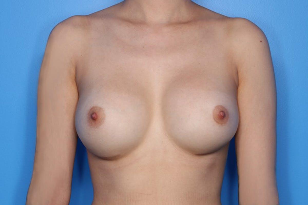 Setty Plastic Surgery breast augmentation after — Frisco, TX