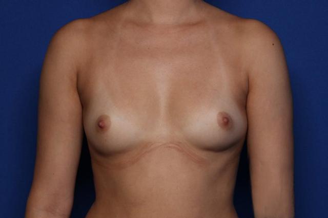 Breast Augmentation before at Setty Plastic Surgery in Frisco, TX