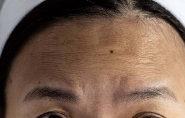 Botox before at NKC Aesthetics in North Kansas City, MO