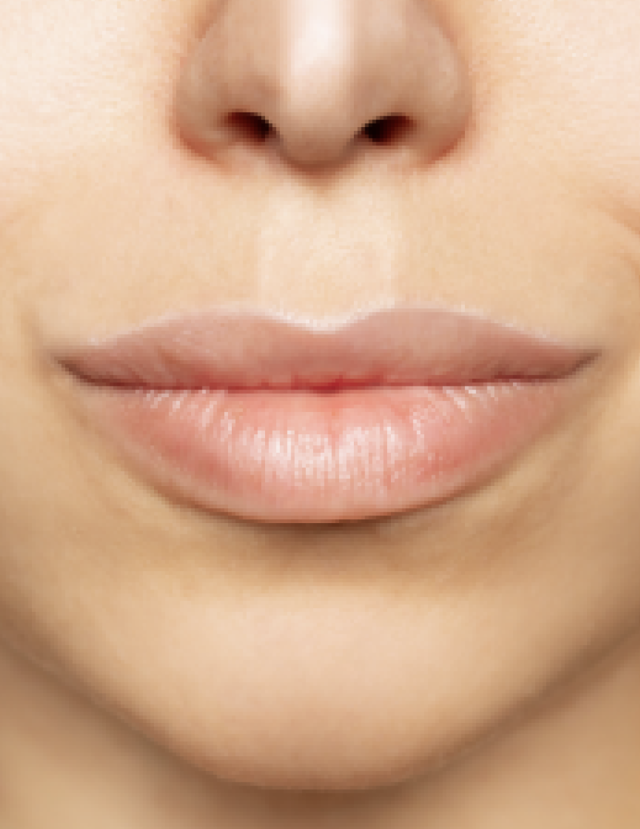 Lip Filler after at NKC Aesthetics in North Kansas City, MO