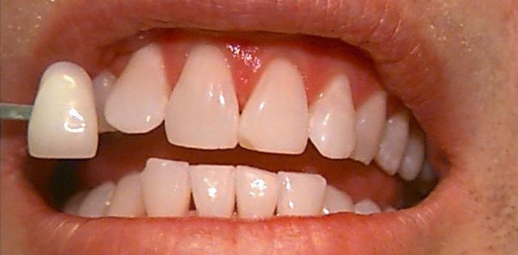 NKC Aesthetics teeth whitening after — North Kansas City, MO