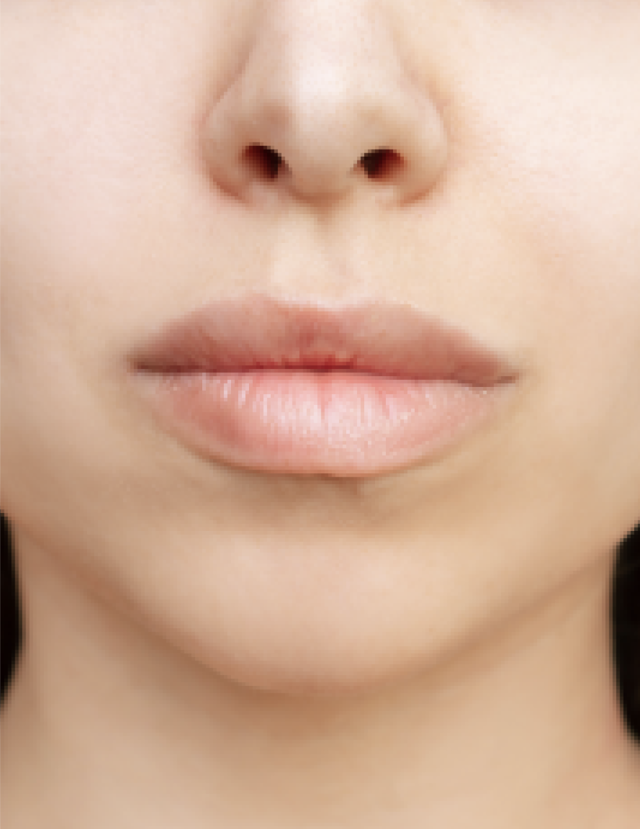 Juvederm after at NKC Aesthetics in North Kansas City, MO
