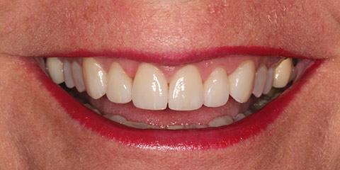 Franklin Smiles smile makeover after — Franklin, TN