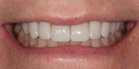 Franklin Smiles smile makeover after — Franklin, TN