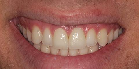 Franklin Smiles smile makeover after — Franklin, TN