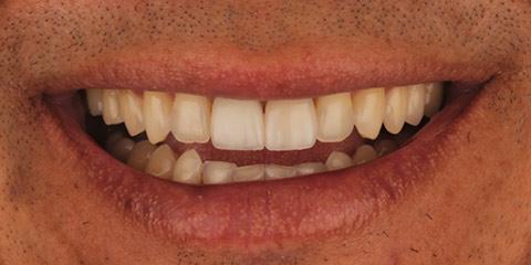 Smile Makeover after at Franklin Smiles in Franklin, TN