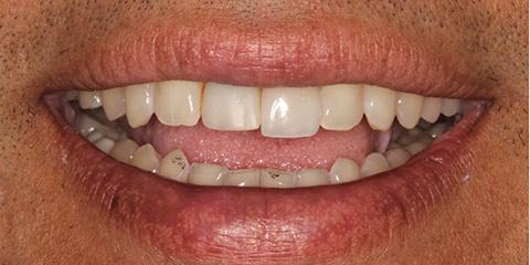 Smile Makeover before at Franklin Smiles in Franklin, TN