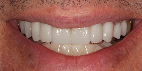 Franklin Smiles smile makeover after — Franklin, TN