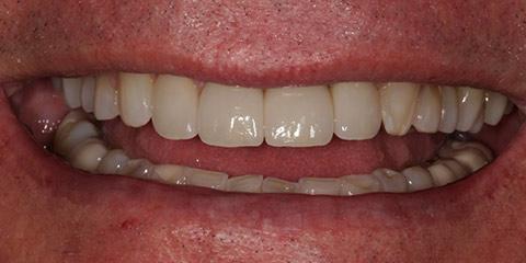 Franklin Smiles smile makeover after — Franklin, TN