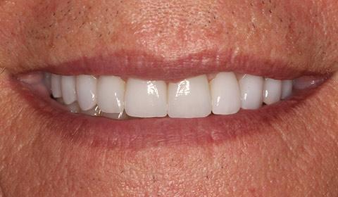 Franklin Smiles smile makeover after — Franklin, TN