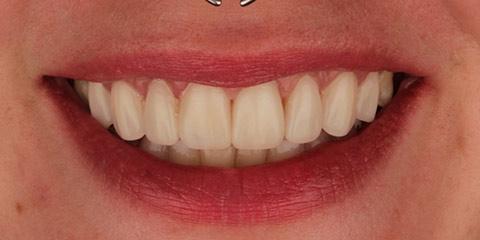 Franklin Smiles smile makeover after — Franklin, TN