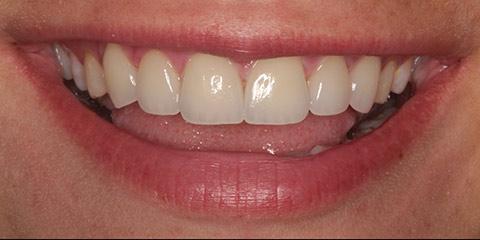 Franklin Smiles smile makeover after — Franklin, TN