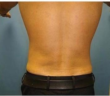 Brazilian Butt Lift result at Dr. Lorelle L. Kramer, MD - Aesthetic and Cosmetic Plastic Surgery Center, LLC of Greater Milwaukee in Wauwatosa, WI