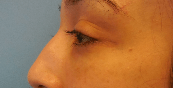 Dr. Lorelle L. Kramer, MD - Aesthetic and Cosmetic Plastic Surgery Center, LLC of Greater Milwaukee lip filler after — Wauwatosa, WI