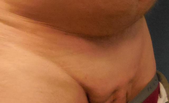 Brazilian Butt Lift result at Dr. Lorelle L. Kramer, MD - Aesthetic and Cosmetic Plastic Surgery Center, LLC of Greater Milwaukee in Wauwatosa, WI