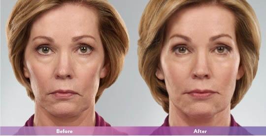 Juvederm result at Dr. Lorelle L. Kramer, MD - Aesthetic and Cosmetic Plastic Surgery Center, LLC of Greater Milwaukee in Wauwatosa, WI