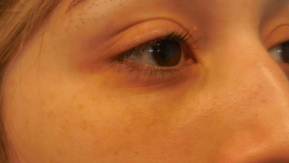 Juvederm after at Dr. Lorelle L. Kramer, MD - Aesthetic and Cosmetic Plastic Surgery Center, LLC of Greater Milwaukee in Wauwatosa, WI