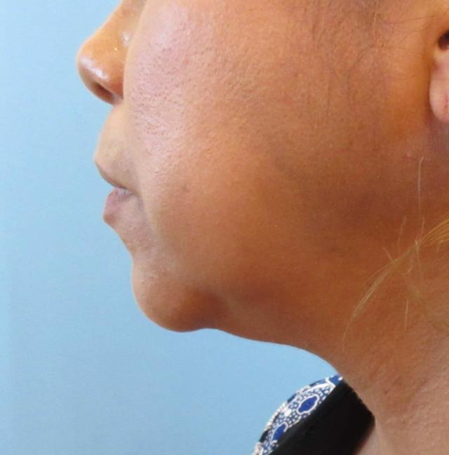 Neck Liposuction before at Dr. Lorelle L. Kramer, MD - Aesthetic and Cosmetic Plastic Surgery Center, LLC of Greater Milwaukee in Wauwatosa, WI