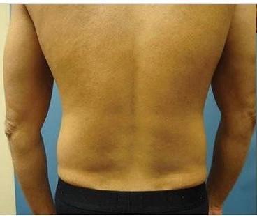 Brazilian Butt Lift result at Dr. Lorelle L. Kramer, MD - Aesthetic and Cosmetic Plastic Surgery Center, LLC of Greater Milwaukee in Wauwatosa, WI