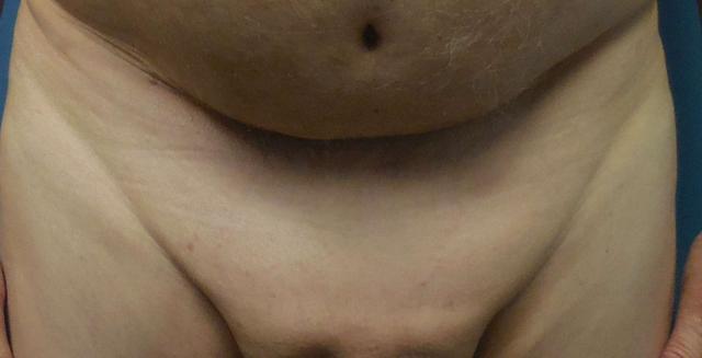 Brazilian Butt Lift result at Dr. Lorelle L. Kramer, MD - Aesthetic and Cosmetic Plastic Surgery Center, LLC of Greater Milwaukee in Wauwatosa, WI