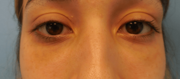 Juvederm after at Dr. Lorelle L. Kramer, MD - Aesthetic and Cosmetic Plastic Surgery Center, LLC of Greater Milwaukee in Wauwatosa, WI
