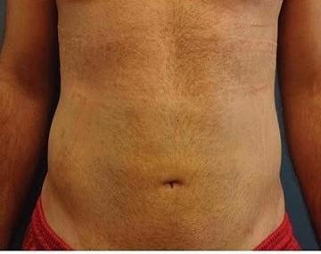 Dr. Lorelle L. Kramer, MD - Aesthetic and Cosmetic Plastic Surgery Center, LLC of Greater Milwaukee liposuction result — Wauwatosa, WI