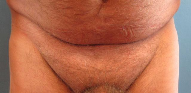 Liposuction result at Dr. Lorelle L. Kramer, MD - Aesthetic and Cosmetic Plastic Surgery Center, LLC of Greater Milwaukee in Wauwatosa, WI