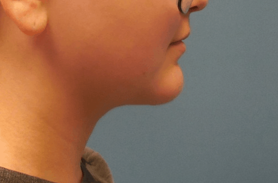 Neck Liposuction after at Dr. Lorelle L. Kramer, MD - Aesthetic and Cosmetic Plastic Surgery Center, LLC of Greater Milwaukee in Wauwatosa, WI