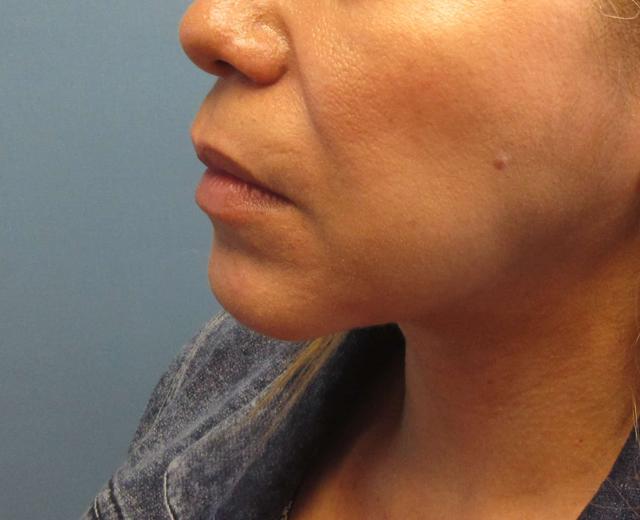 Neck Liposuction after at Dr. Lorelle L. Kramer, MD - Aesthetic and Cosmetic Plastic Surgery Center, LLC of Greater Milwaukee in Wauwatosa, WI