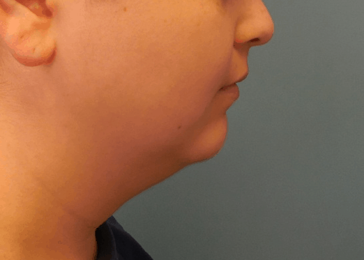 Neck Liposuction before at Dr. Lorelle L. Kramer, MD - Aesthetic and Cosmetic Plastic Surgery Center, LLC of Greater Milwaukee in Wauwatosa, WI