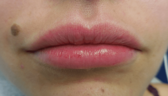 Dr. Lorelle L. Kramer, MD - Aesthetic and Cosmetic Plastic Surgery Center, LLC of Greater Milwaukee lip filler after — Wauwatosa, WI