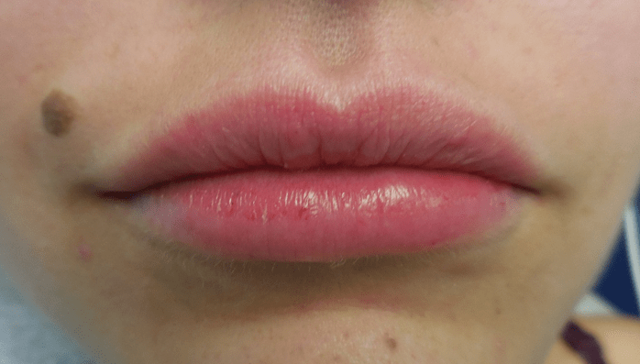 Juvederm after at Dr. Lorelle L. Kramer, MD - Aesthetic and Cosmetic Plastic Surgery Center, LLC of Greater Milwaukee in Wauwatosa, WI