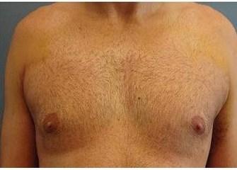 Dr. Lorelle L. Kramer, MD - Aesthetic and Cosmetic Plastic Surgery Center, LLC of Greater Milwaukee liposuction result — Wauwatosa, WI