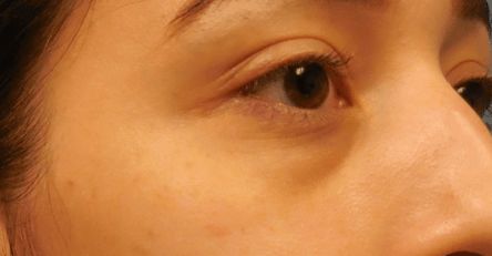 Juvederm before at Dr. Lorelle L. Kramer, MD - Aesthetic and Cosmetic Plastic Surgery Center, LLC of Greater Milwaukee in Wauwatosa, WI