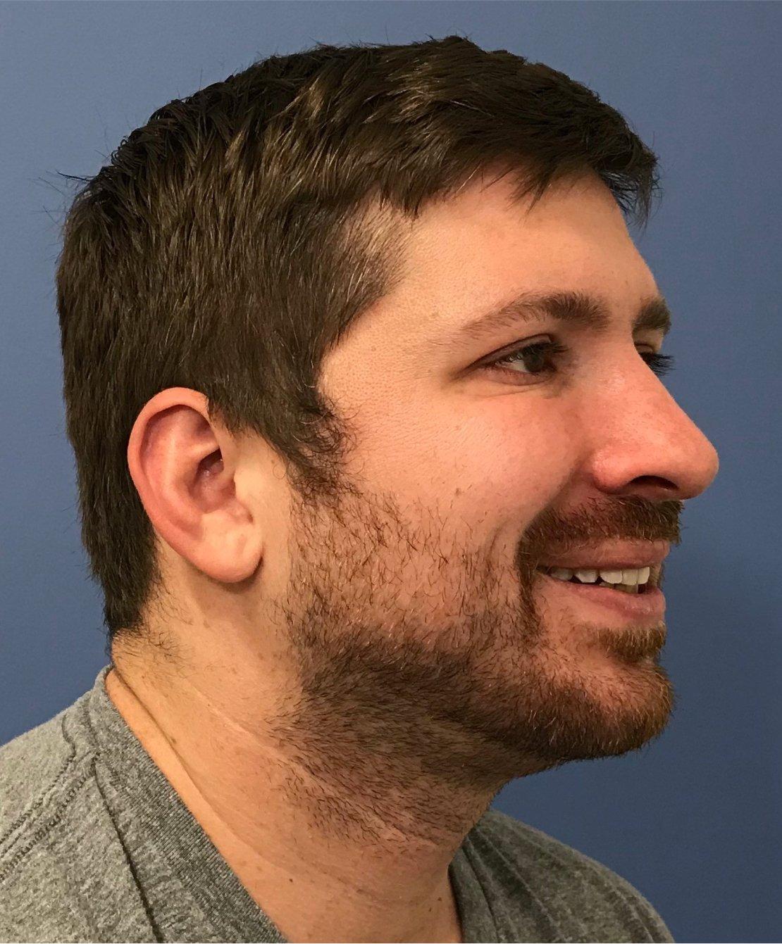 Renew Aesthetic & Laser Clinic in Portland after — Portland, OR