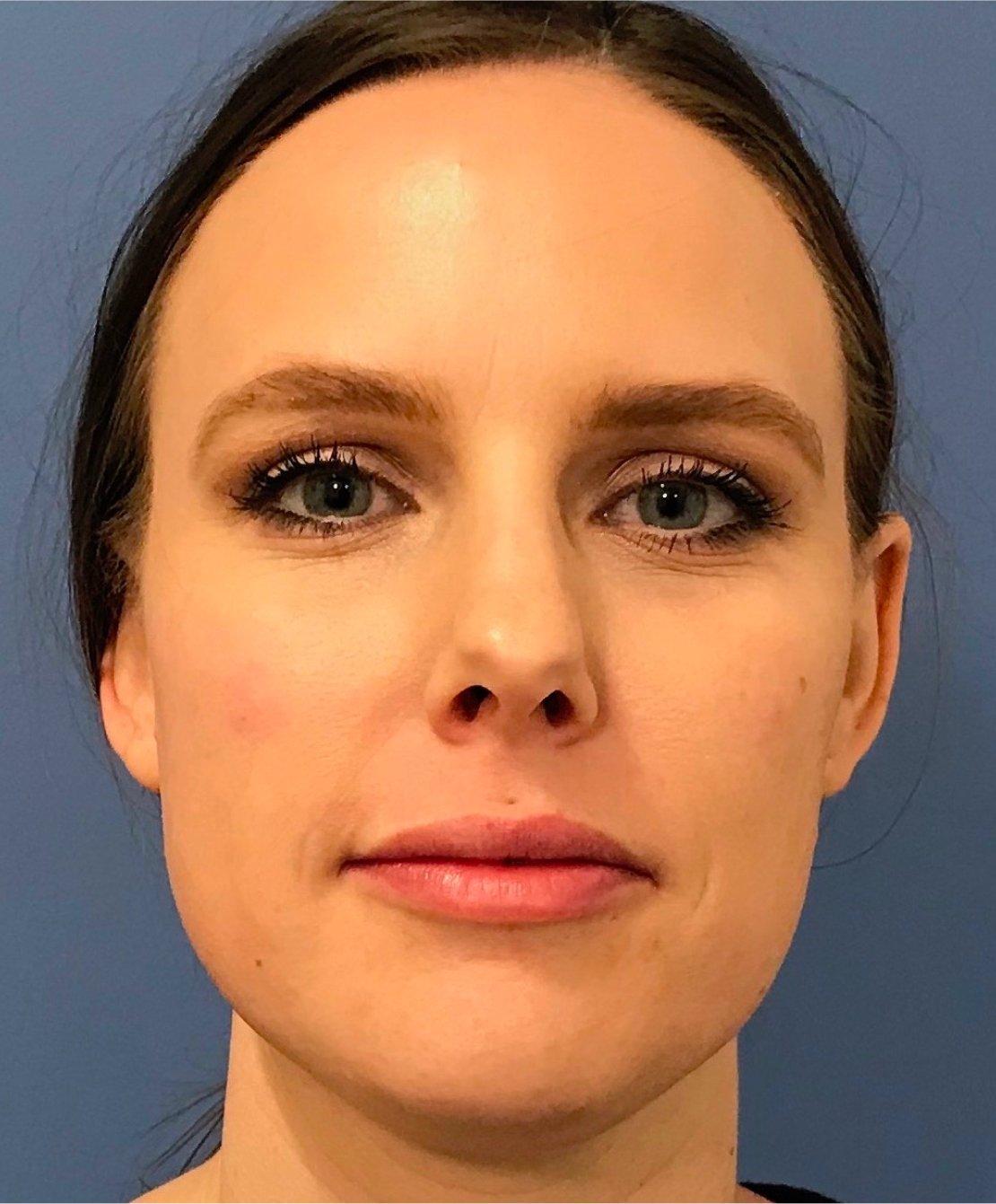 Renew Aesthetic & Laser Clinic in Portland after — Portland, OR