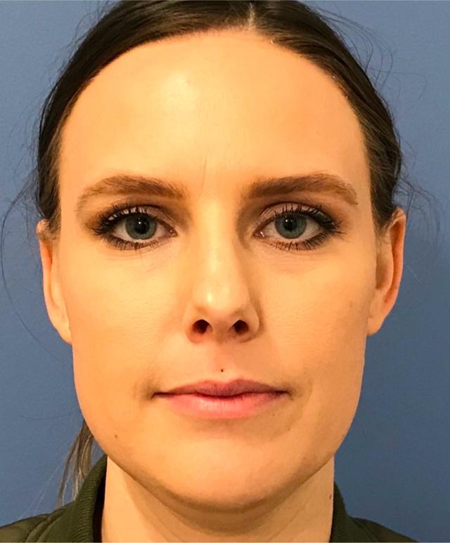Botox before at Renew Aesthetic & Laser Clinic in Portland in Portland, OR
