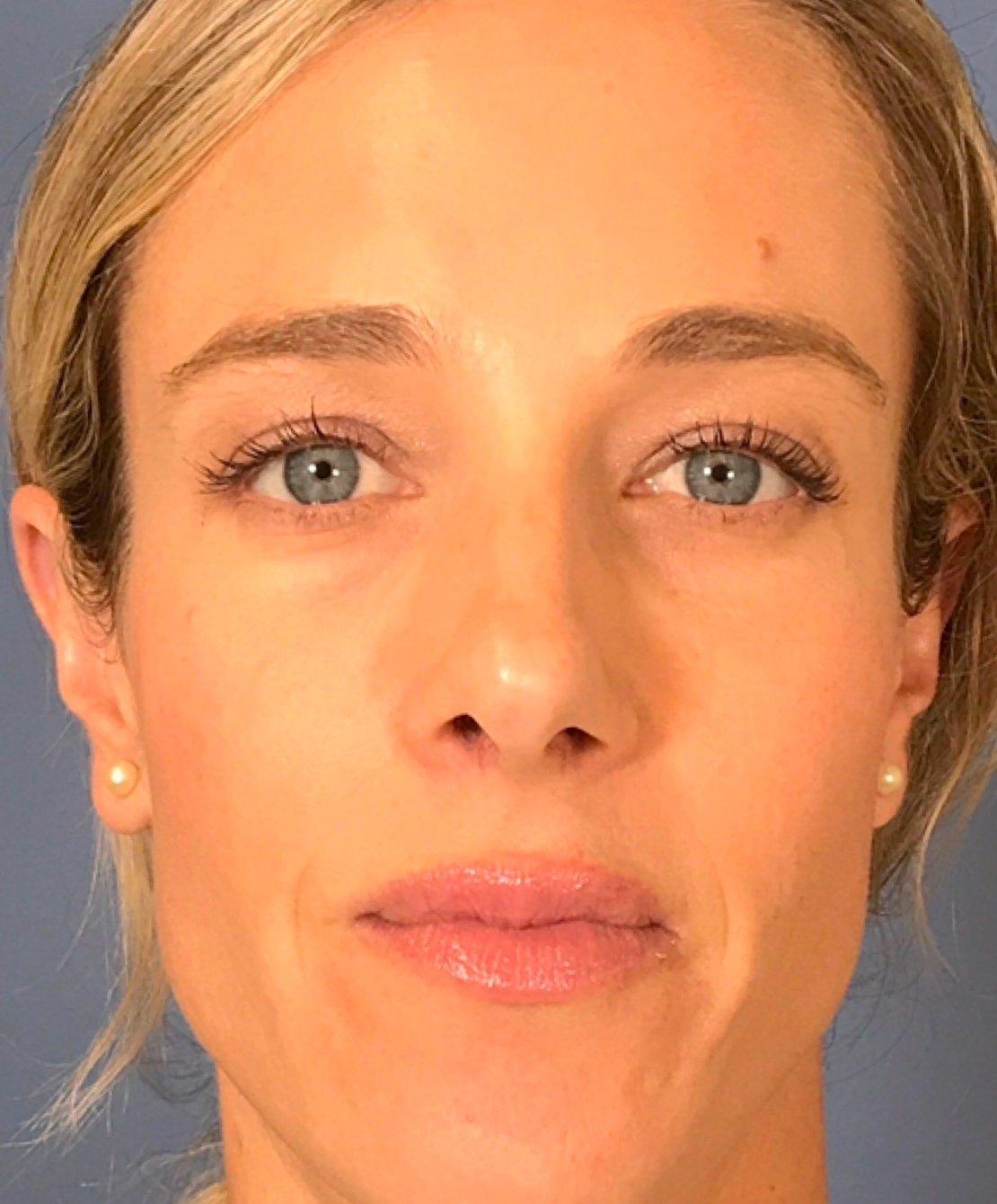 Renew Aesthetic & Laser Clinic in Portland after — Portland, OR