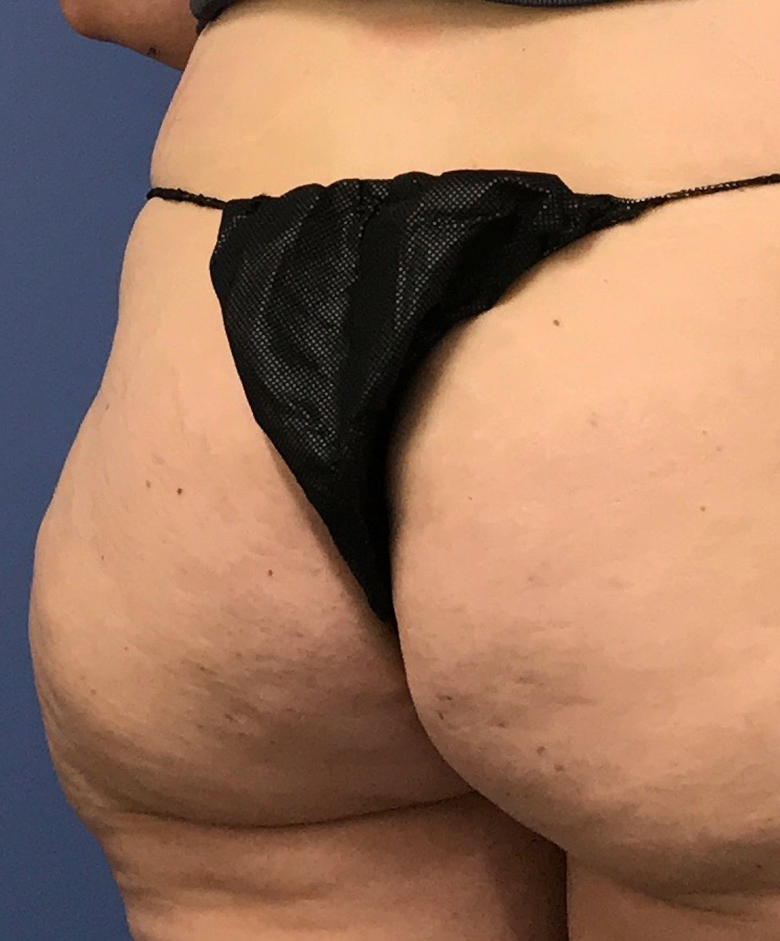Renew Aesthetic & Laser Clinic in Portland after — Portland, OR