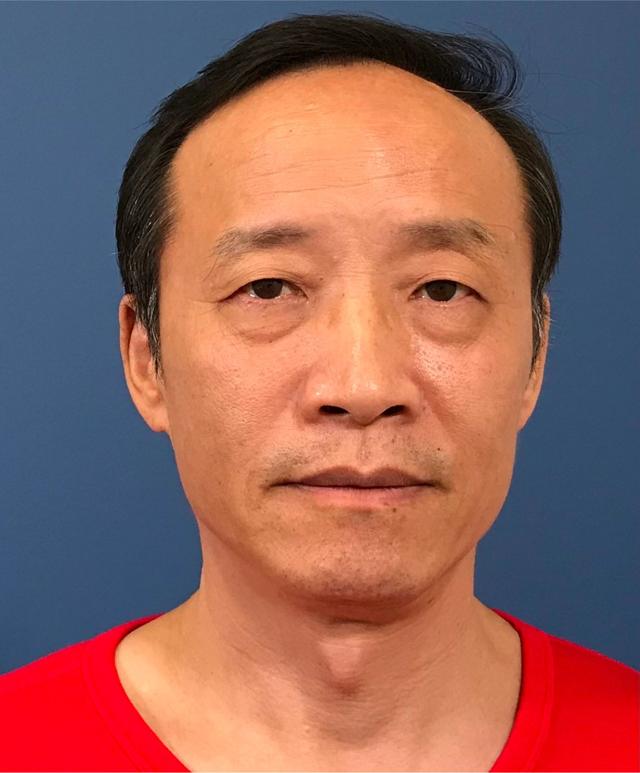 Blepharoplasty after at Renew Aesthetic & Laser Clinic in Portland in Portland, OR