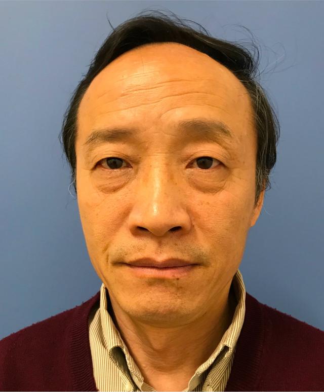Blepharoplasty before at Renew Aesthetic & Laser Clinic in Portland in Portland, OR