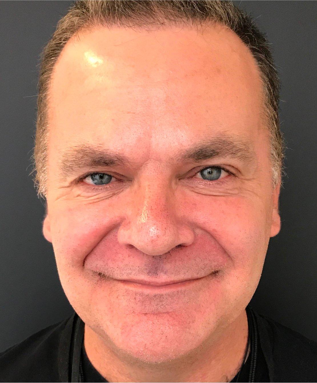 Renew Aesthetic & Laser Clinic in Portland after — Portland, OR