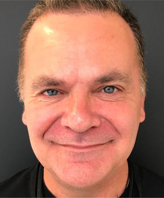 Botox after at Renew Aesthetic & Laser Clinic in Portland in Portland, OR
